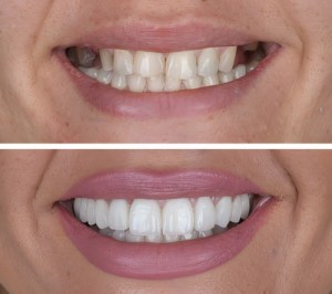 Teeth Whitening before and afters