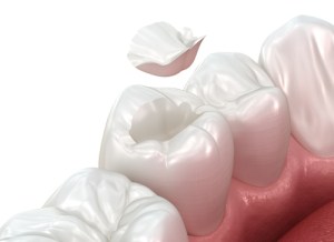A 3D medical illustration of a molar tooth showing a dental inlay or onlay procedure. A custom-fit white ceramic piece is shown hovering above a prepared cavity in the tooth's crown, demonstrating how the restoration fits into the natural tooth structure.
